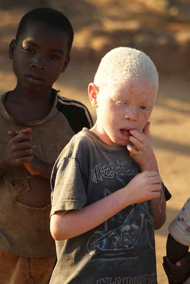 In Ländern wie Malawi, Mosambik, Tansania und Simbabwe werden immer wieder Albinos angegriffen, getötet und verstümmelt, weil ihren Körperteilen glücksbringende und magische Kräfte zugesprochen werden. (Foto: JJ Hoefnagel/Wikipedia)